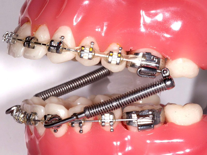 Cabinet d'Orthodontie Blanchard - Les Appareillages - Activateur squelettique fixe