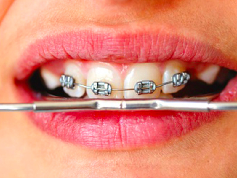 Cabinet d'Orthodontie Blanchard - Les Appareillages - Ancrage extra oral