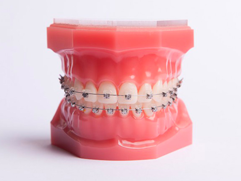 Cabinet d'Orthodontie Blanchard - Les Appareillages - Appareil multibagues