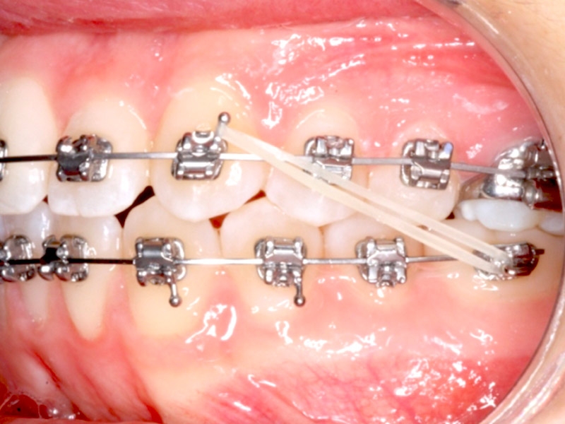 Cabinet d'Orthodontie Blanchard - Les Appareillages - Élastiques